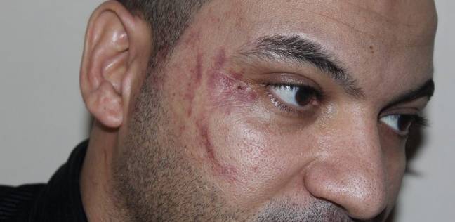 Bruises on El-Sayed's face as a result of the beating he received at the restaurant.